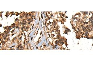 Immunohistochemistry of paraffin-embedded Human ovarian cancer tissue using CAMKK1 Polyclonal Antibody at dilution of 1:35(x200) (CAMKK1 antibody)