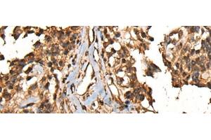 Immunohistochemistry of paraffin-embedded Human ovarian cancer tissue using CAMKK1 Polyclonal Antibody at dilution of 1:35(x200)