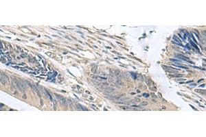 Immunohistochemistry of paraffin-embedded Human colorectal cancer tissue using NPHP1 Polyclonal Antibody at dilution of 1:60(x200) (NPHP1 antibody)