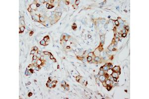 Anti-SKP2 antibody, IHC(P) IHC(P): Human Mammary Cancer Tissue (SKP2 antibody  (N-Term))