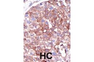 Formalin-fixed and paraffin-embedded human cancer tissue reacted with the primary antibody, which was peroxidase-conjugated to the secondary antibody, followed by DAB staining. (SMURF1 antibody  (C-Term))