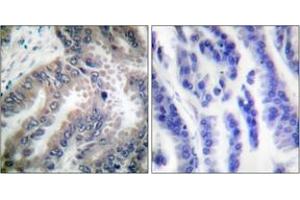 Immunohistochemistry analysis of paraffin-embedded human lung carcinoma tissue, using Caspase 8 (Ab-347) Antibody. (Caspase 8 antibody  (AA 313-362))