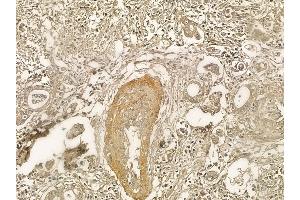 Vinculin Mouse Monoclonal Antibody at 1/100 staining human pancreatic cancer and adjacent non-tumor tissue by IHC-P. (Vinculin antibody  (N-Term))