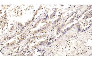 Detection of ACO1 in Human Lung cancer Tissue using Polyclonal Antibody to Aconitase 1 (ACO1) (Aconitase 1 antibody  (AA 26-243))