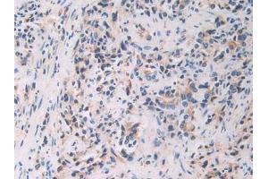 Detection of FBLN1 in Human Prostate cancer Tissue using Polyclonal Antibody to Fibulin 1 (FBLN1) (Fibulin 1 antibody  (AA 176-398))