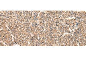 Immunohistochemistry of paraffin-embedded Human liver cancer tissue using RCAN3 Polyclonal Antibody at dilution of 1:60(x200) (RCAN3 antibody)