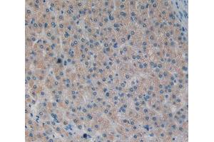 IHC-P analysis of liver cancer tissue, with DAB staining. (MOK antibody  (AA 173-418))
