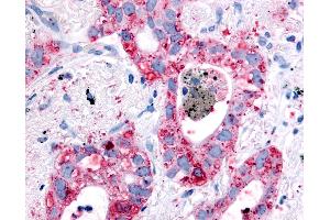 Anti-EGFR antibody IHC of human Lung, Non-Small Cell Carcinoma. (EGFR antibody)