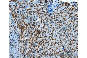 Immunohistochemistry of Human cervical cancer using CREB1 Polyclonal Antibody at dilution of 1:30 (CREB1 antibody)