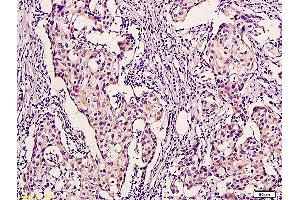 Formalin-fixed and paraffin embedded human breast carcinoma labeled with Anti-Rad51 Polyclonal Antibody, Unconjugated (ABIN673584) at 1:200 followed by conjugation to the secondary antibody and DAB staining. (RAD51 antibody  (AA 241-339))