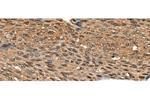 Immunohistochemistry of paraffin-embedded Human esophagus cancer tissue using CALML5 Polyclonal Antibody at dilution of 1:70(x200) (CALML5 antibody)