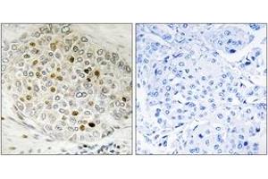 Immunohistochemistry analysis of paraffin-embedded human breast carcinoma tissue, using HDAC5 (Ab-498) Antibody. (HDAC5 antibody  (AA 464-513))
