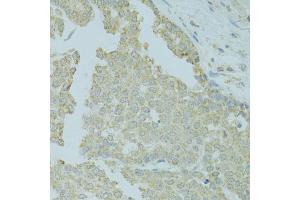 Immunohistochemistry of paraffin-embedded human colon carcinoma using MTFP1 antibody (ABIN5975088) at dilution of 1/100 (40x lens). (Mtfp1 antibody)