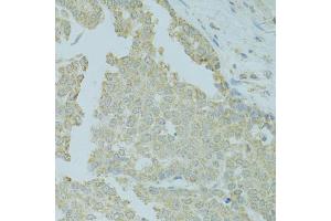 Immunohistochemistry of paraffin-embedded human colon carcinoma using MTFP1 antibody (ABIN5975088) at dilution of 1/100 (40x lens). (Mtfp1 antibody)