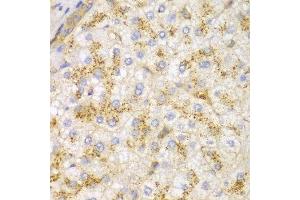 Immunohistochemistry of paraffin-embedded human liver cancer using ACTN1 antibody at dilution of 1:100 (400x lens). (ACTN1 antibody)