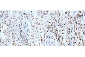 Immunohistochemistry of paraffin-embedded Human lung cancer tissue using BRD3 Polyclonal Antibody at dilution of 1:60(x200) (BRD3 antibody)