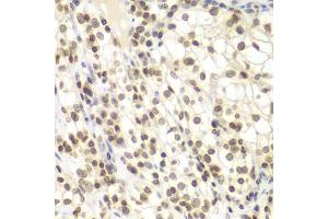 Immunohistochemistry of paraffin-embedded human kidney cancer using UHRF2 antibody (ABIN6133264, ABIN6149911, ABIN6149913 and ABIN6217665) at dilution of 1:200 (40x lens). (UHRF2 antibody  (AA 441-622))