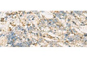 Immunohistochemistry of paraffin-embedded Human cervical cancer tissue using VTA1 Polyclonal Antibody at dilution of 1:60(x200) (VTA1 antibody)