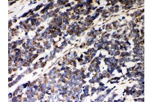 Anti- Peroxiredoxin 5 Picoband antibody, IHC(P) IHC(P): Human Lung Cancer Tissue (Peroxiredoxin 5 antibody  (AA 66-198))
