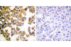 Peptide - +Immunohistochemistry analysis of paraffin-embedded human breast carcinoma tissue using BAD antibody. (BAD antibody  (Internal Region))