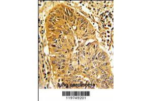 Formalin-fixed and paraffin-embedded human lung carcinoma with CALD1 Antibody , which was peroxidase-conjugated to the secondary antibody, followed by DAB staining. (Caldesmon antibody  (AA 428-457))