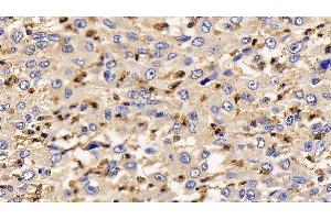 Detection of IL13Ra2 in Human Liver cancer Tissue using Polyclonal Antibody to Interleukin 13 Receptor Alpha 2 (IL13Ra2) (IL13RA2 antibody  (AA 238-334))