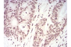 Immunohistochemical analysis of paraffin-embedded rectum cancer tissues using TERT mouse mAb with DAB staining. (TERT antibody  (AA 1029-1132))