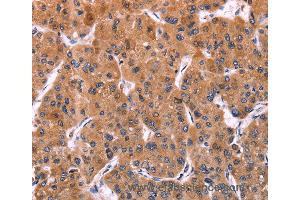 Immunohistochemistry of Human liver cancer using ERP29 Polyclonal Antibody at dilution of 1:40 (ERP29 antibody)