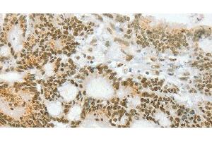 Immunohistochemistry of paraffin-embedded Human colon cancer using ANGPT4 Polyclonal Antibody at dilution of 1:70 (Angiopoietin 4 antibody)