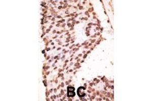 Formalin-fixed and paraffin-embedded human cancer tissue reacted with the primary antibody, which was peroxidase-conjugated to the secondary antibody, followed by AEC staining. (MMP7 antibody  (AA 117-146))