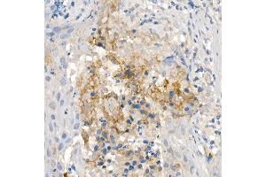 Immunohistochemistry of paraffin-embedded human esophageal cancer using CNTN4 Rabbit mAb (ABIN7266495) at dilution of 1:100 (40x lens). (Contactin 4 antibody)