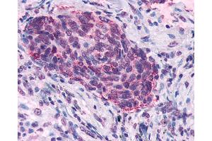 Anti-SSTR5 antibody IHC of human Lung, Small Cell Carcinoma.