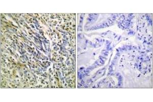 Immunohistochemistry analysis of paraffin-embedded human lung carcinoma tissue, using Aggrecan (Cleaved-Asp369) Antibody. (Aggrecan antibody  (Cleaved-Asp369))