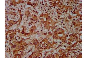 IHC image of ABIN7148760 diluted at 1:600 and staining in paraffin-embedded human liver cancer performed on a Leica BondTM system. (Cullin 7 antibody  (AA 312-450))