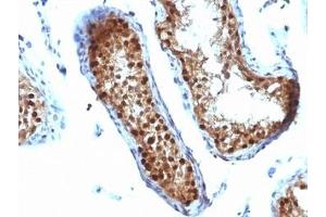 Formalin-fixed, paraffin-embedded human testicular carcinoma stained with SUMO-2 antibody. (SUMO2 antibody)