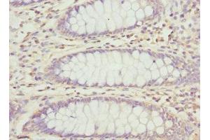 Immunohistochemistry of paraffin-embedded human colon cancer using ABIN7162995 at dilution of 1:100 (PECR antibody  (AA 24-303))