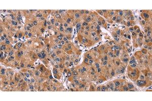 Immunohistochemistry of paraffin-embedded Human liver cancer tissue using LILRB1 Polyclonal Antibody at dilution 1:50 (LILRB1 antibody)