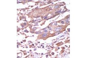 Formalin-fixed and paraffin-embedded human cancer tissue (breast carcinoma) reacted with the primary antibody, which was peroxidase-conjugated to the secondary antibody, followed by AEC staining. (CAMK2A antibody  (C-Term))