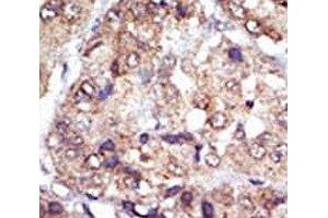 IHC analysis of FFPE human hepatocarcinoma tissue stained with the LYN antibody (LYN antibody  (AA 32-62))