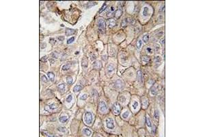Formalin-fixed and paraffin-embedded human lung carcinoma tissue reacted with CLIC1 antibody, which was peroxidase-conjugated to the secondary antibody, followed by DAB staining. (CLIC1 antibody)