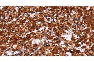 Immunohistochemistry of paraffin-embedded Human thyroid cancer tissue using HIPK1 Polyclonal Antibody at dilution 1:30 (HIPK1 antibody)