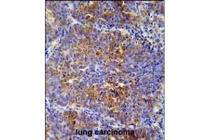 MCAF2 Antibody immunohistochemistry analysis in formalin fixed and paraffin embedded human lung carcinoma followed by peroxidase conjugation of the secondary antibody and DAB staining. (ATF7IP2 antibody  (AA 318-347))