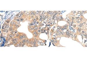 Immunohistochemistry of paraffin-embedded Human gastric cancer tissue using EPHA6 Polyclonal Antibody at dilution of 1:40(x200) (EPH Receptor A6 antibody)
