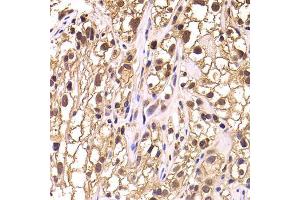 Immunohistochemistry of paraffin-embedded human kidney cancer using TCEB3 antibody (ABIN5975459) at dilution of 1/100 (40x lens). (TCEB3 antibody)