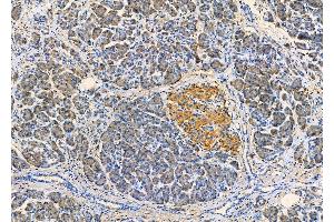 ABIN6261372 and ABIN6279351 at 1/100 staining Human pancreatic cancer and adjacent nomal tissues by IHC-P. (Desmoglein 3 antibody  (C-Term))