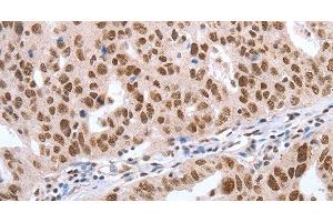 Immunohistochemistry of paraffin-embedded Human ovarian cancer tissue using Oct-6 Polyclonal Antibody at dilution 1:40 (POU3F1 antibody)