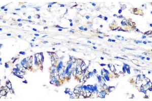 Immunohistochemistry of paraffin-embedded Human colon carcinoma using PBEF / NAMPT Polyclonal Antibody at dilution of 1:100 (40x lens). (NAMPT antibody)
