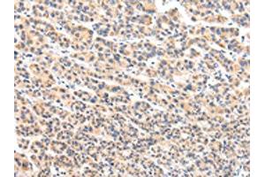 The image on the left is immunohistochemistry of paraffin-embedded Human liver cancer tissue using ABIN7131592(VPS54 Antibody) at dilution 1/20, on the right is treated with fusion protein. (VPS54 antibody)