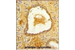 Formalin-fixed and paraffin-embedded human prostate carcinoma reacted with DAB2 Antibody (C-term), which was peroxidase-conjugated to the secondary antibody, followed by DAB staining.