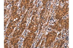 The image on the left is immunohistochemistry of paraffin-embedded Human gastric cancer tissue using ABIN7192526(SLC8A2 Antibody) at dilution 1/15, on the right is treated with synthetic peptide. (SLC8A2 antibody)